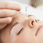 Eficacia de la acupuntura